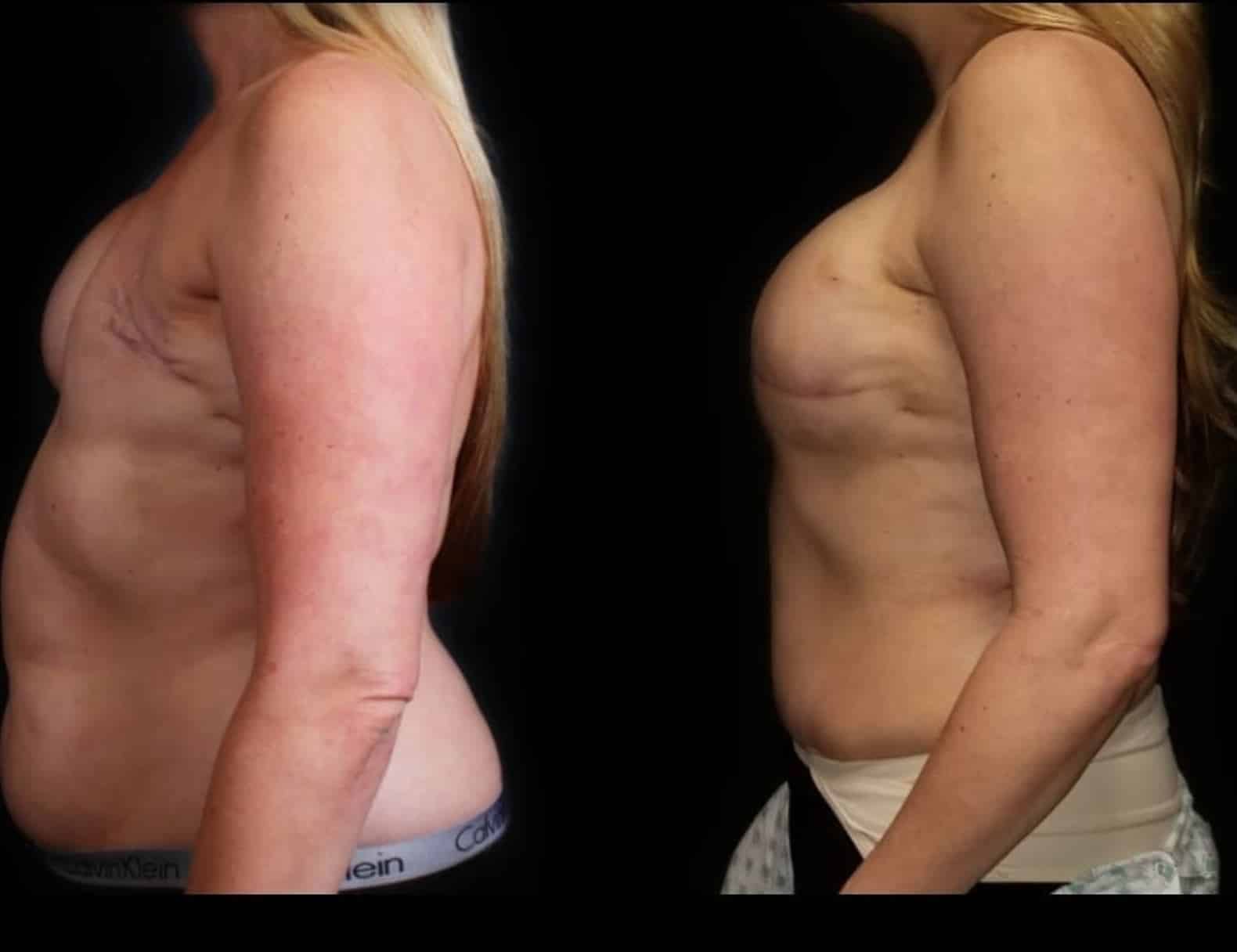 Flap_based_reconstruction